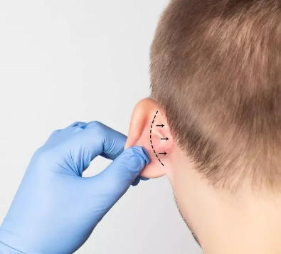 Otomodelação Definitiva